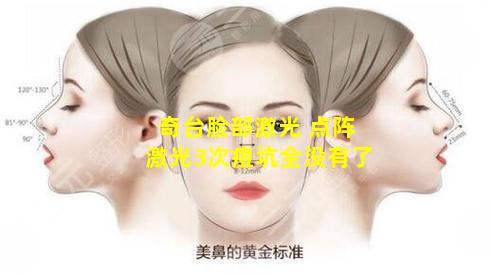 奇台脸部激光 点阵激光3次痘坑全没有了